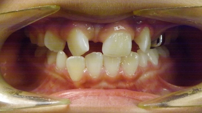 before and after Richmond orthodontist