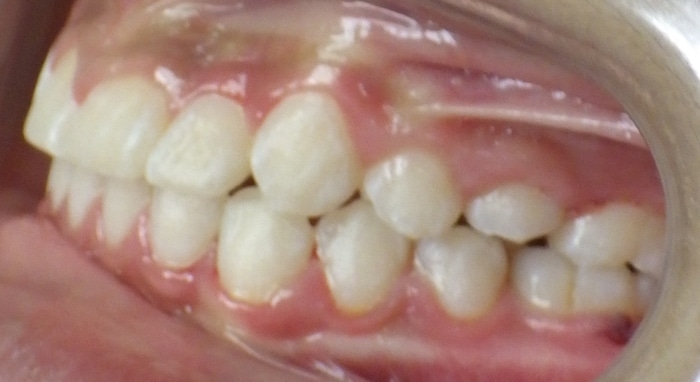 Christopher before and after Richmond orthodontist