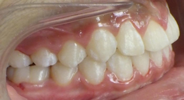 Christopher before and after Richmond orthodontist