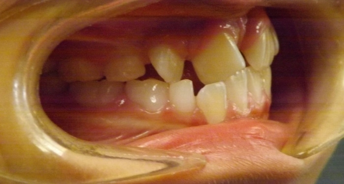 Christopher before and after Richmond orthodontist