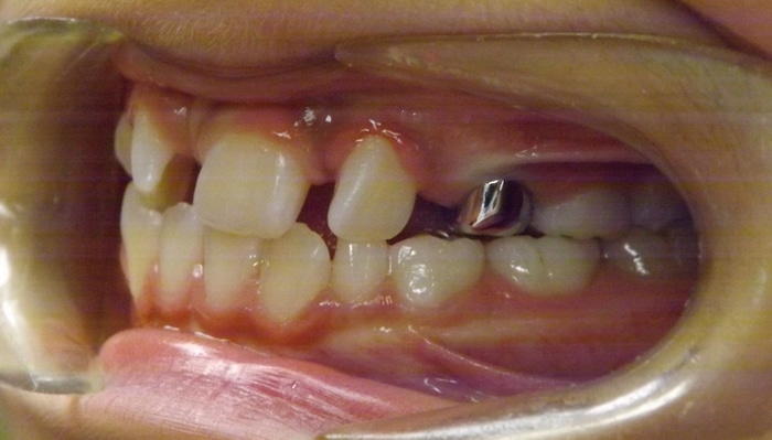 Christopher before and after Richmond orthodontist