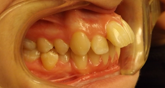 before and after Richmond orthodontist