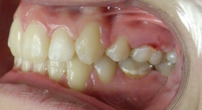 before and after Richmond orthodontist