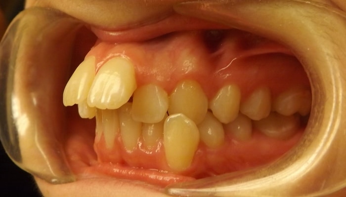 before and after Richmond orthodontist