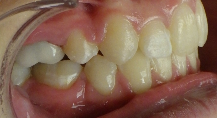 before and after Richmond orthodontist