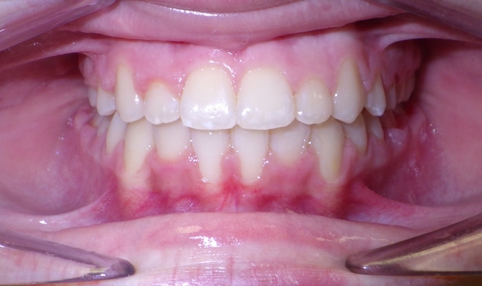 before and after Richmond orthodontist