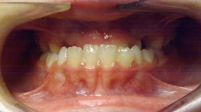 before and after Richmond orthodontist