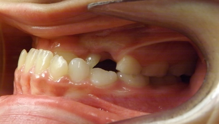before and after Richmond orthodontist