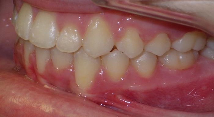 before and after Richmond orthodontist