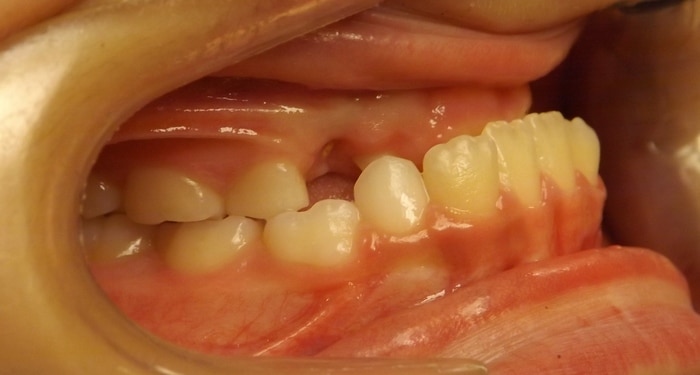 before and after Richmond orthodontist