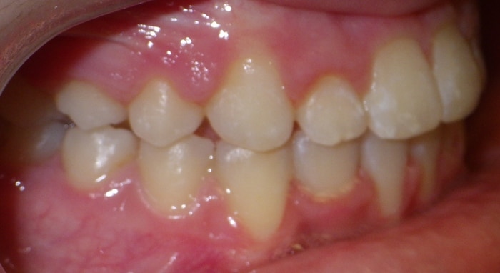 before and after Richmond orthodontist