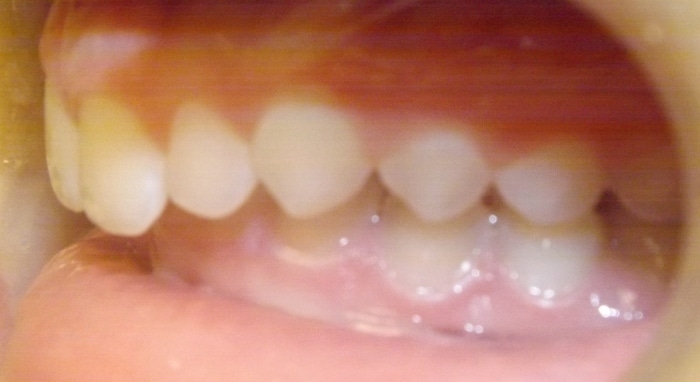 before and after Richmond orthodontist