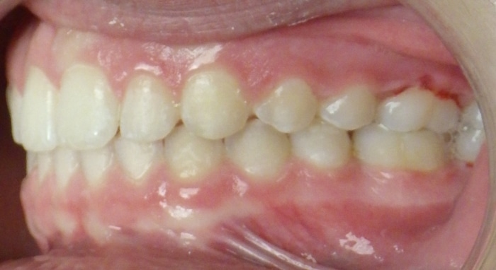 before and after Richmond orthodontist