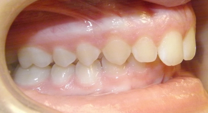 before and after Richmond orthodontist