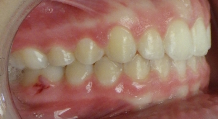 before and after richmond orthodontist