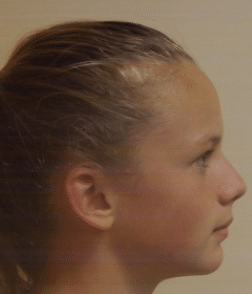 Marlea side view before Richmond Orthodontist