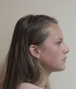 Marlea side view after Richmond Orthodontist