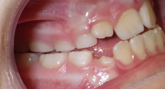 Orthodontics at PDOVA Richmond VA