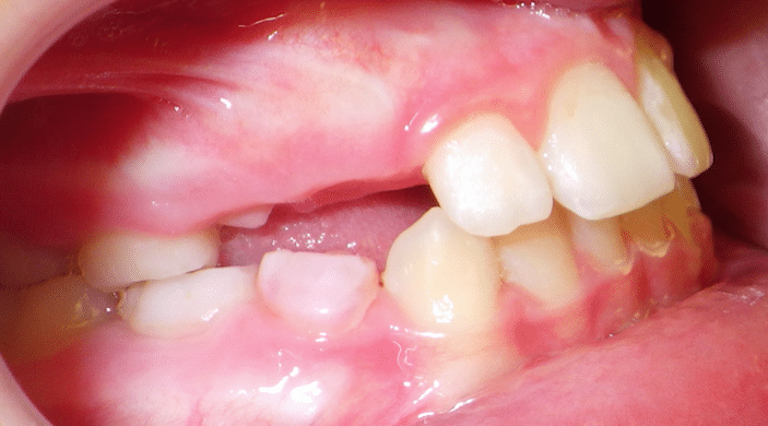 Orthodontics at PDOVA Richmond VA