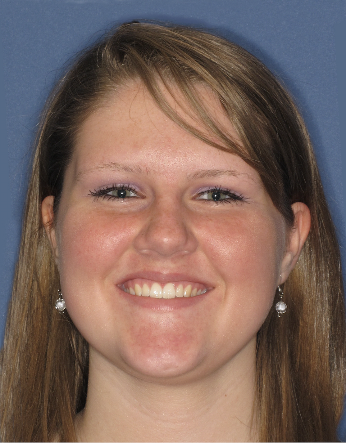 Invisalign SmileView