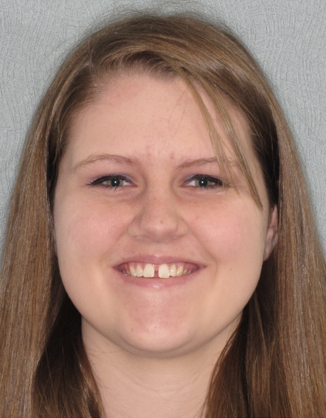 Invisalign SmileView